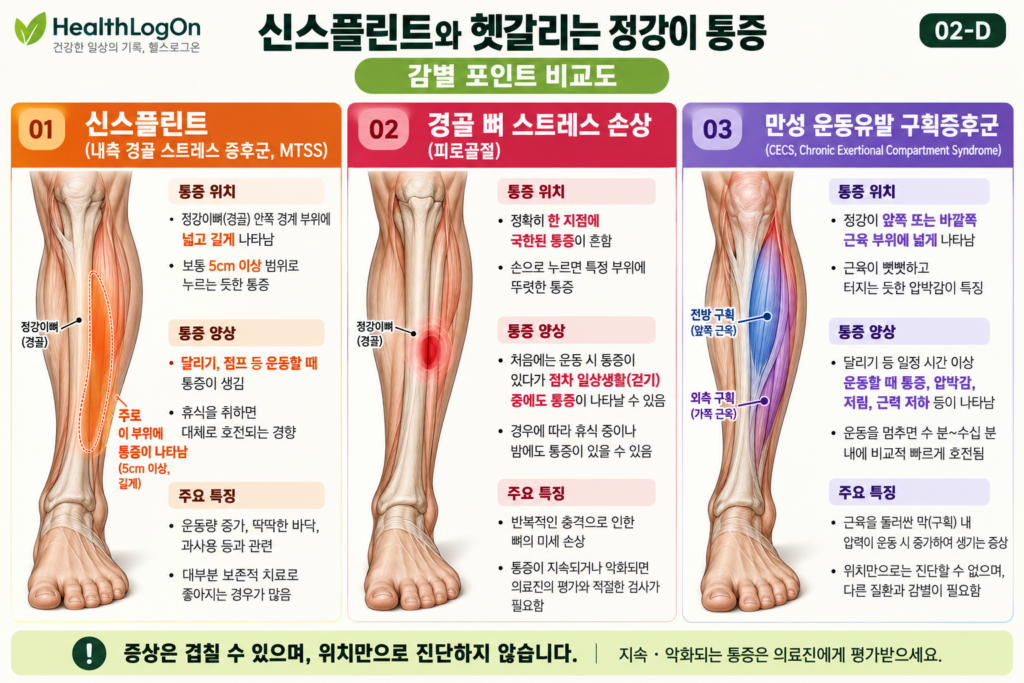 신스플린트와 경골 뼈 스트레스 손상, 만성 운동유발 구획증후군의 통증 영역과 대표 증상, 특징을 3개 열로 정리한 비교 인포그래픽