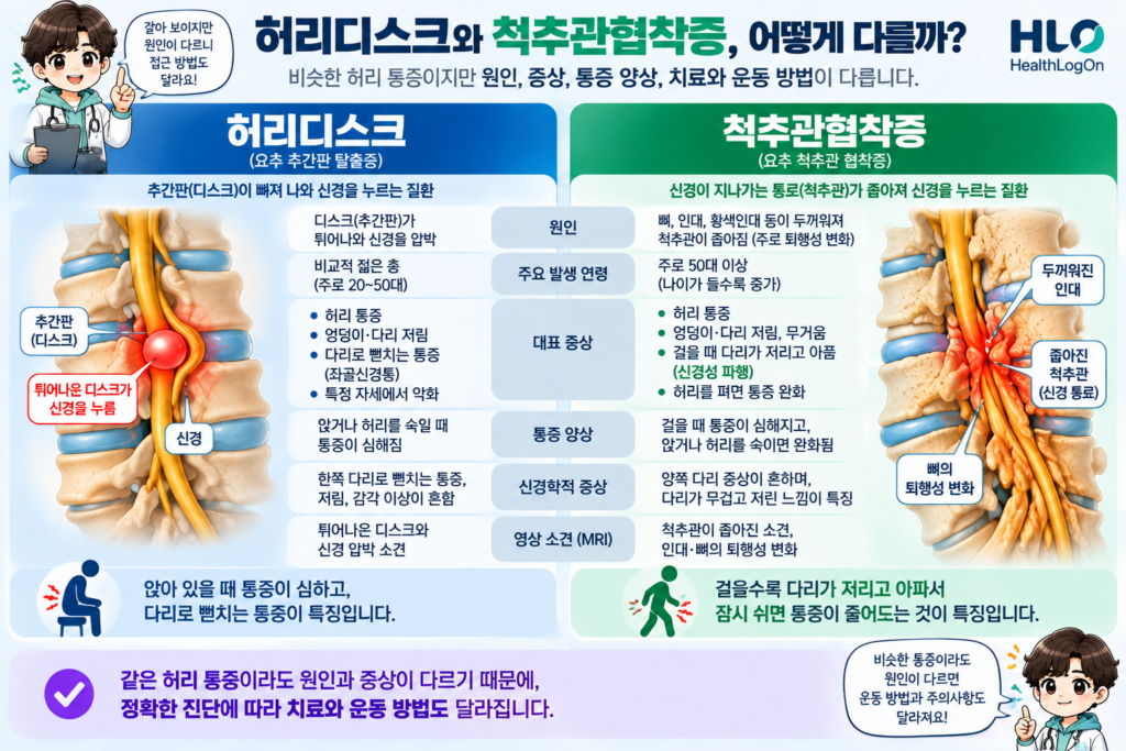 허리디스크와 척추관협착증에서 흔히 나타날 수 있는 허리 및 다리 증상과 보행 시 변화, 예외를 비교하는 표